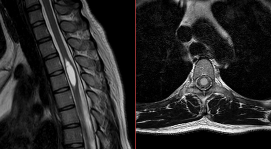 胸椎MRI-脊椎空洞症2