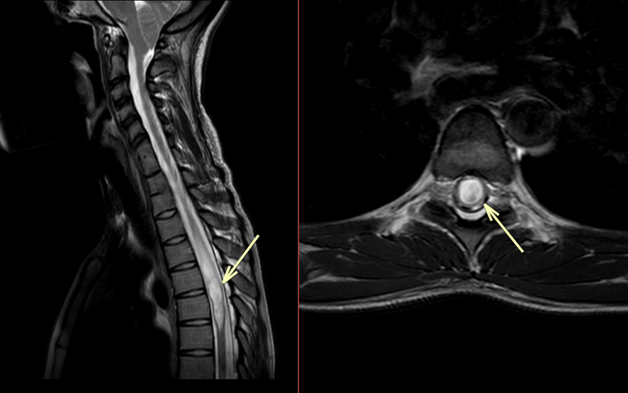 胸椎MRI-脊椎空洞症3