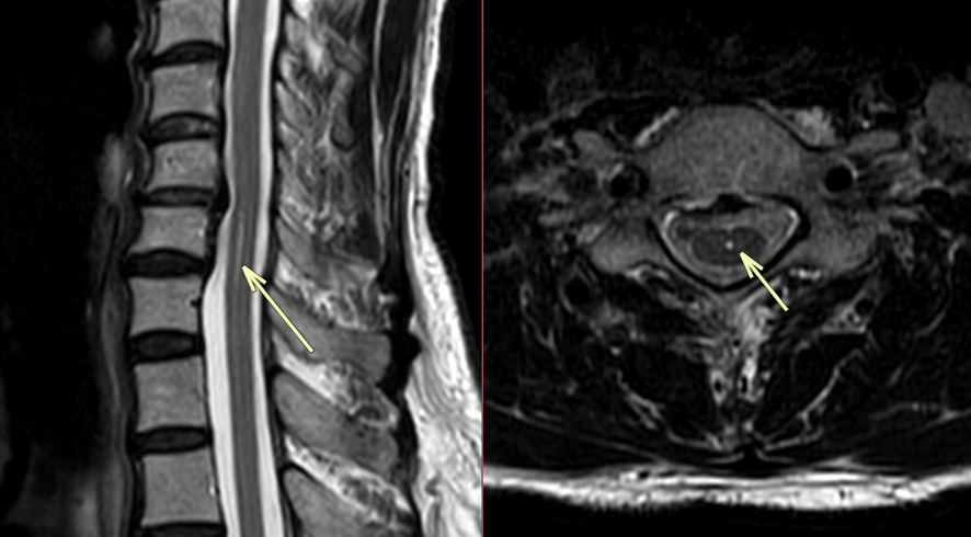 頚椎MRI-中心管遺残