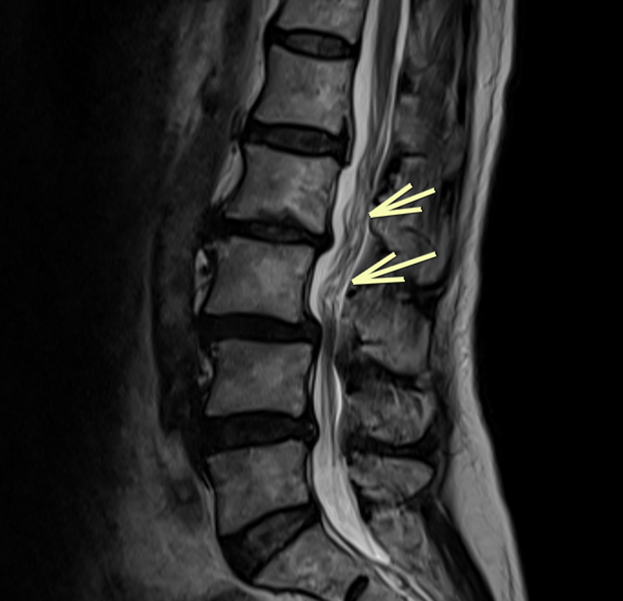 腰椎MRI-馬尾弛緩
