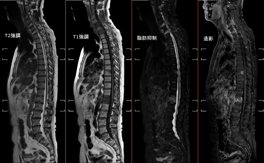 全脊椎MRI-骨転移