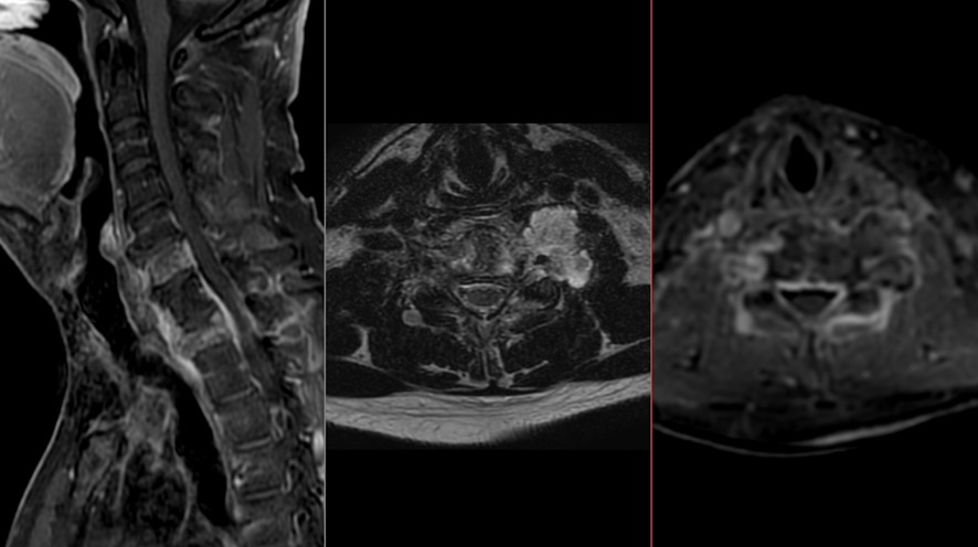 頚椎MRI-骨転移