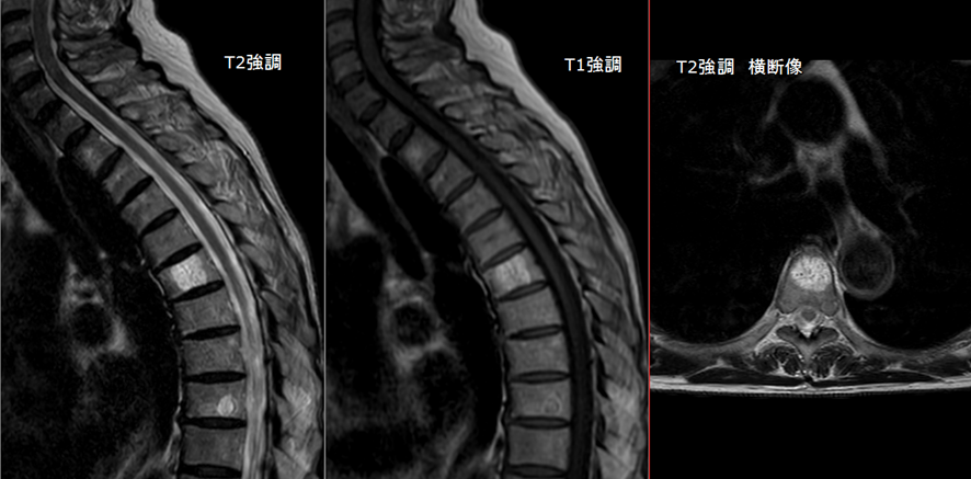 胸椎MRI-脊椎血管腫