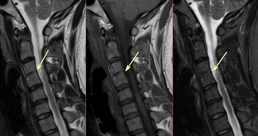 頚椎MRI-癒合椎
