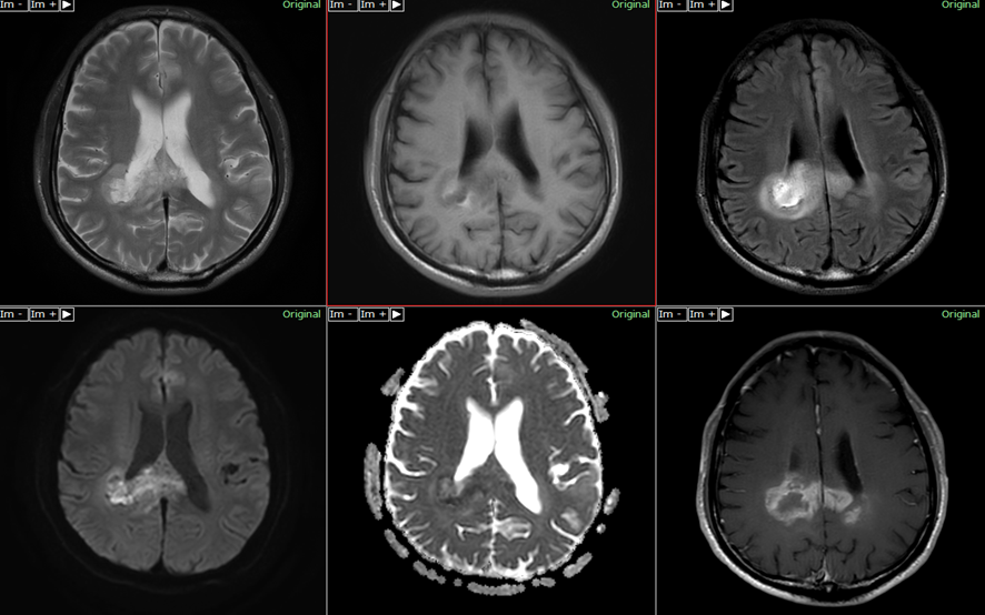 頭部MRI-退形成星細胞腫