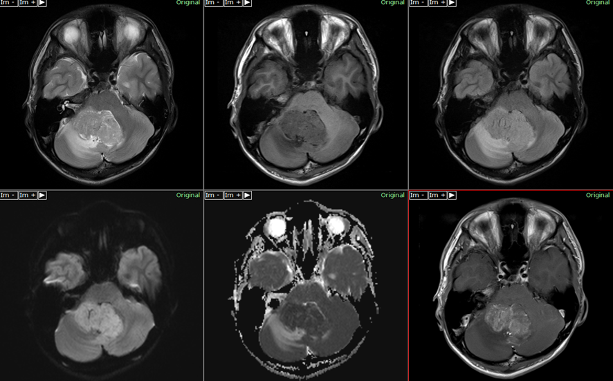 頭部MRI-上衣腫