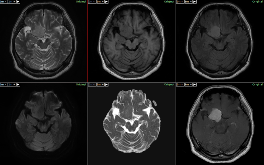 頭部MRI-髄膜腫