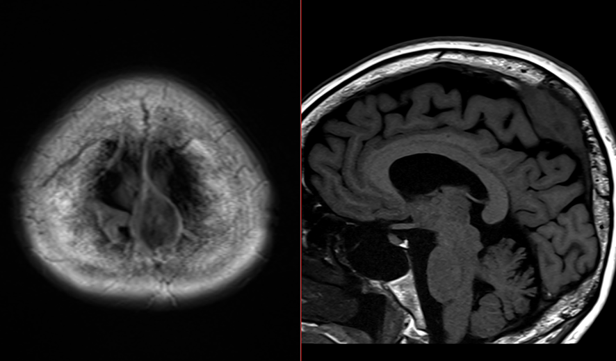 頭部MRI-dural-tail-sign2