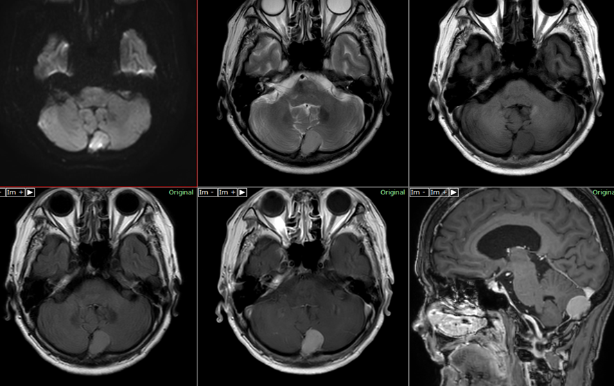 頭部MRI-小脳髄膜腫