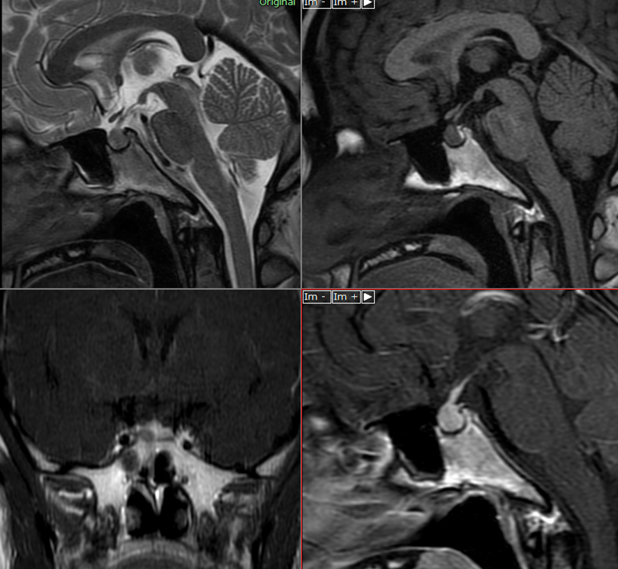 頭部MRI-下垂体腺腫