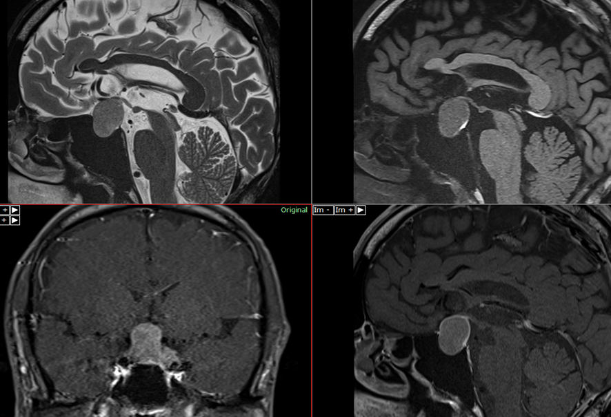 頭部MRI-macroadenoma