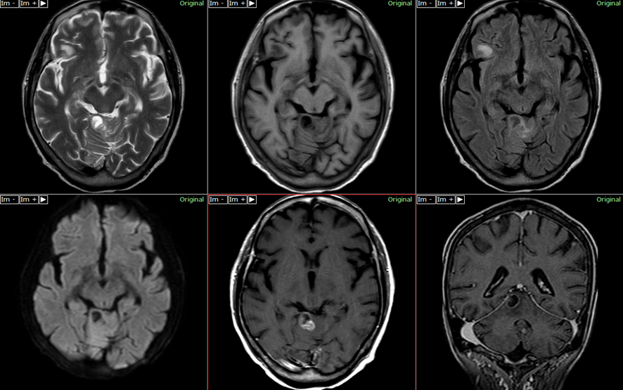 頭部MRI-脳転移