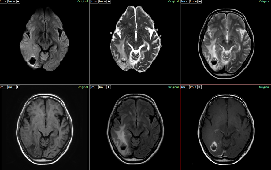 頭部MRI-大脳転移