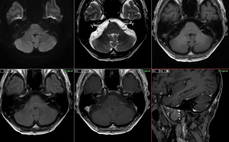 頭部MRI-小脳転移