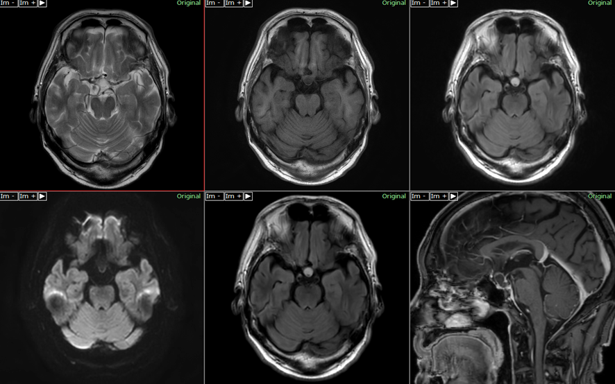 頭部MRI-ラトケ嚢胞