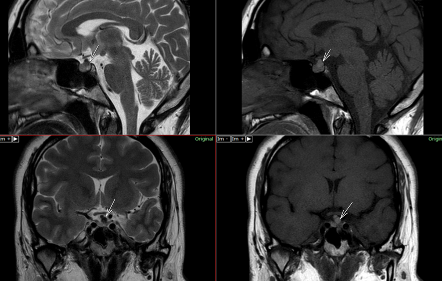 頭部MRI-ラトケ嚢胞2