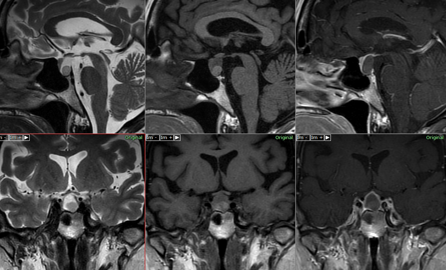頭部MRI-ラトケ嚢胞（complecated-cyst）