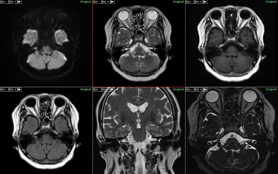 頭部MRI-聴神経腫瘍3