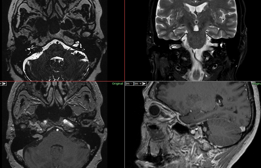 頭部MRI-聴神経腫瘍2