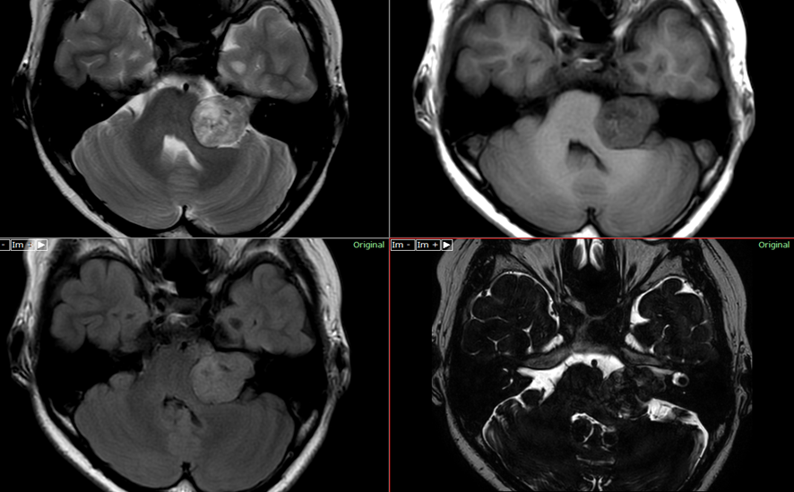 頭部MRI-聴神経腫瘍