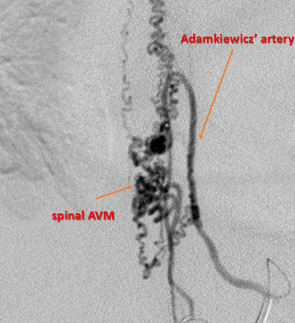 adamkiewicz' artery