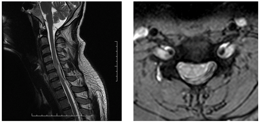 頚椎MRI-硬膜外血腫2