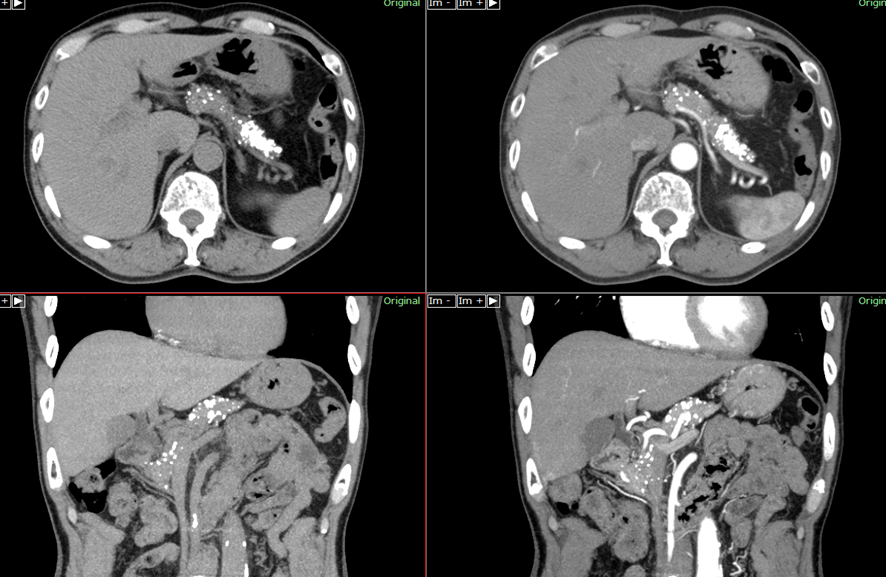 腹部CT　慢性膵炎