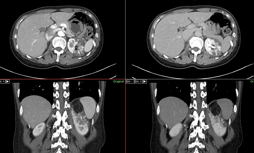 腹部CT　AMLと腎梗塞