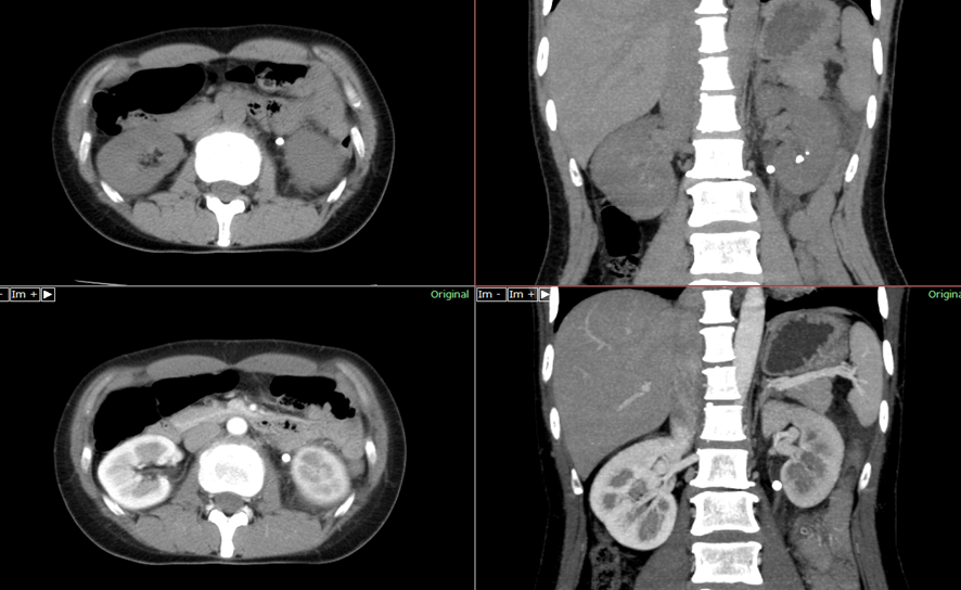 腹部CT　腎～尿管結石