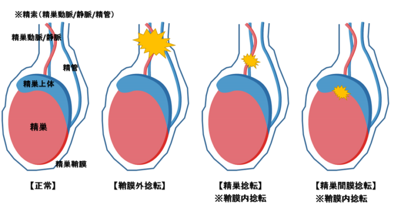 精巣捻転（testicular torsion）