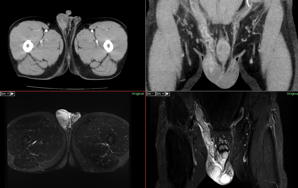 精巣捻転の症状は何ですか?