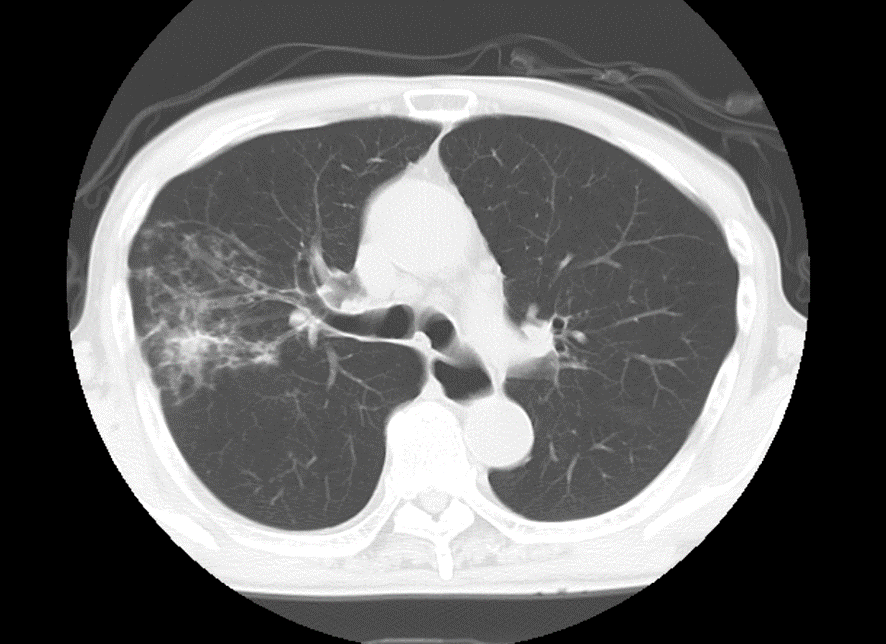 胸部CT-気管支性肺炎