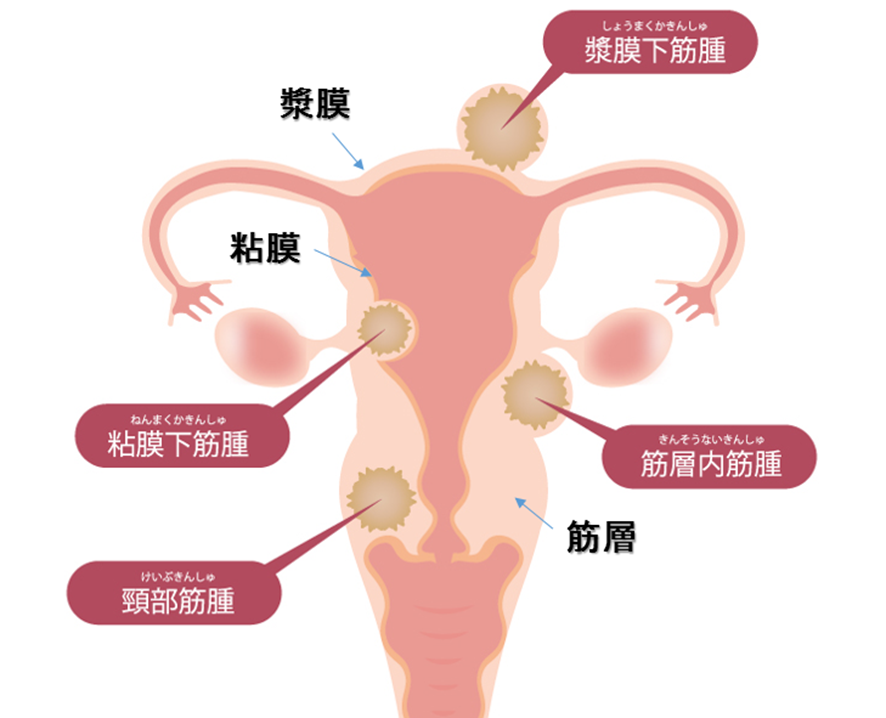 子宮筋腫　種類