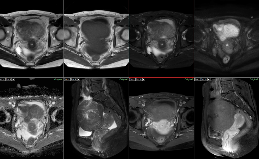 骨盤MRI　子宮筋腫捻転　2方向