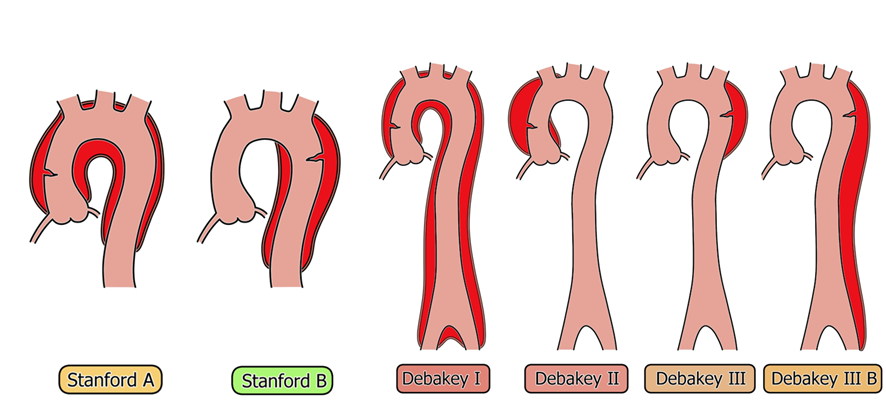 大動脈解離　分類（stanford,debakey）