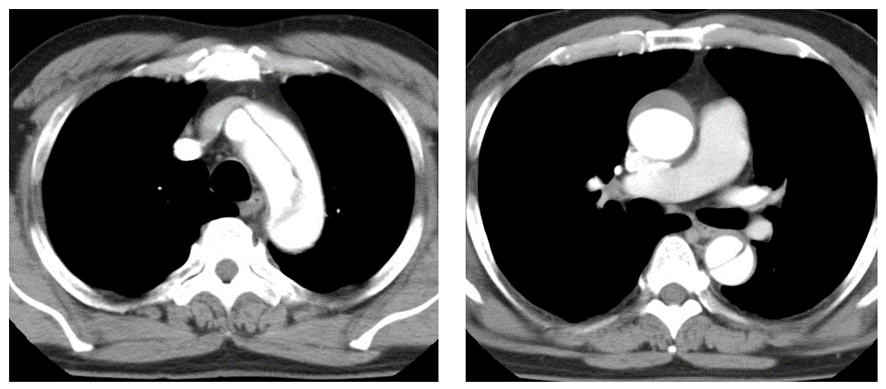 胸部CT画像　大動脈解離　StanfordA型