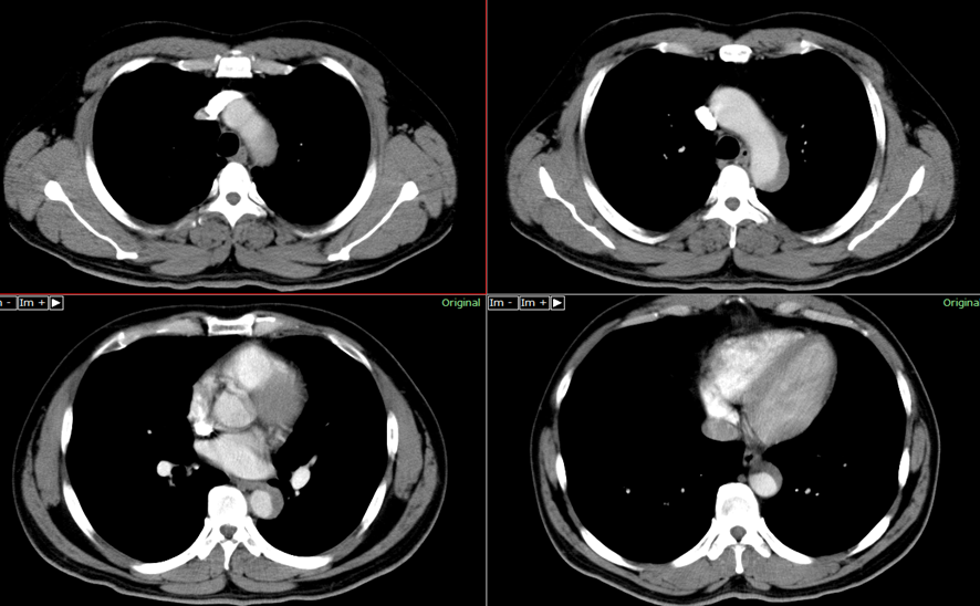 胸部CT画像　大動脈解離　偽腔閉塞型