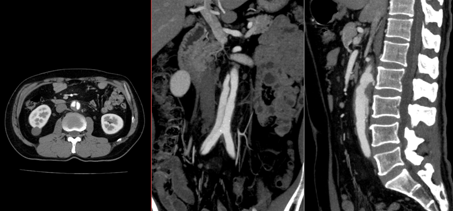 腹部CT画像　大動脈解離
