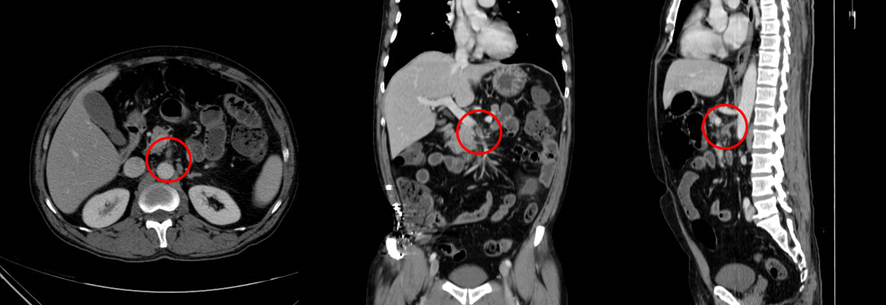 腹部CT　3方向　上腸間膜動脈塞栓