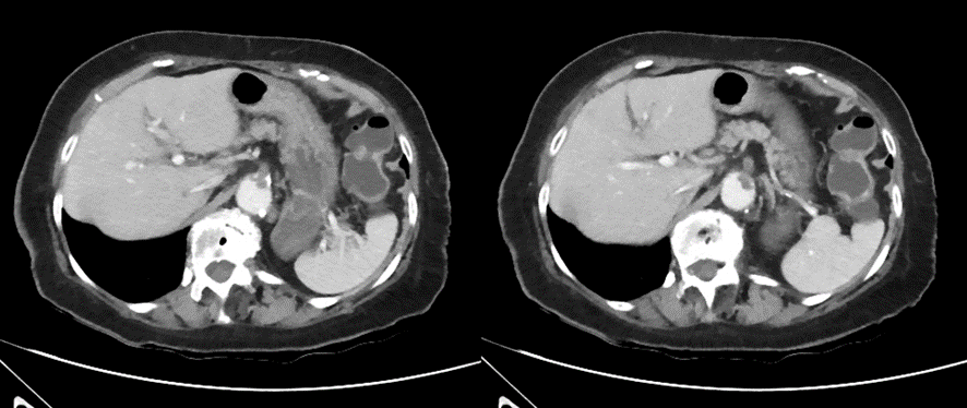 腹部CT画像　上腸管膜塞栓症