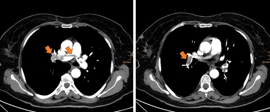 胸部CT画像　肺血栓塞栓症