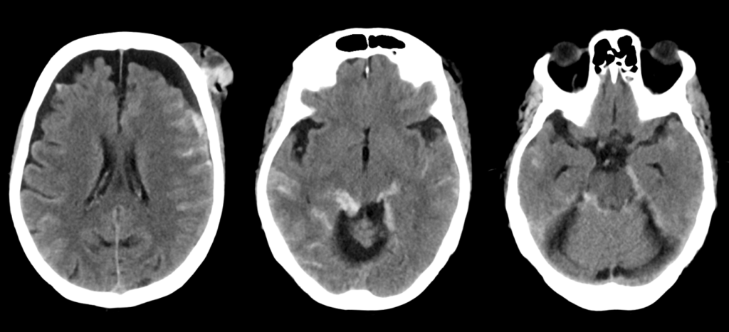 頭部CT画像　外傷性クモ膜下出血