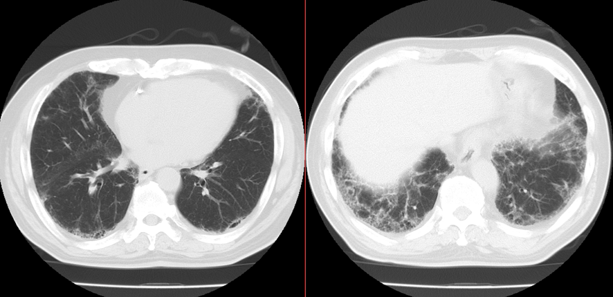胸部CT-間質性肺炎-ガラス陰影、網状影、蜂巣肺