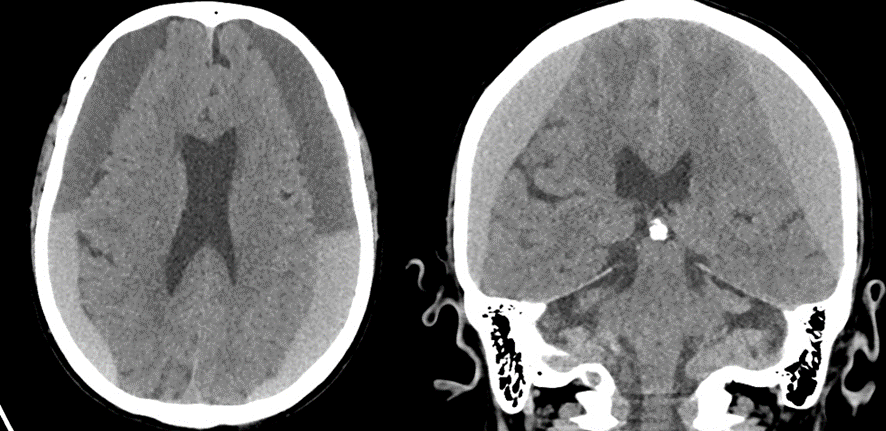 頭部CT画像　硬膜下血腫