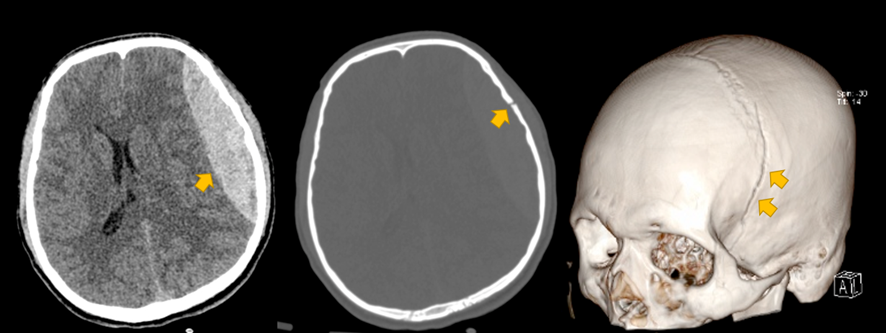 頭部CT画像　頭部骨折　急性硬膜下血腫