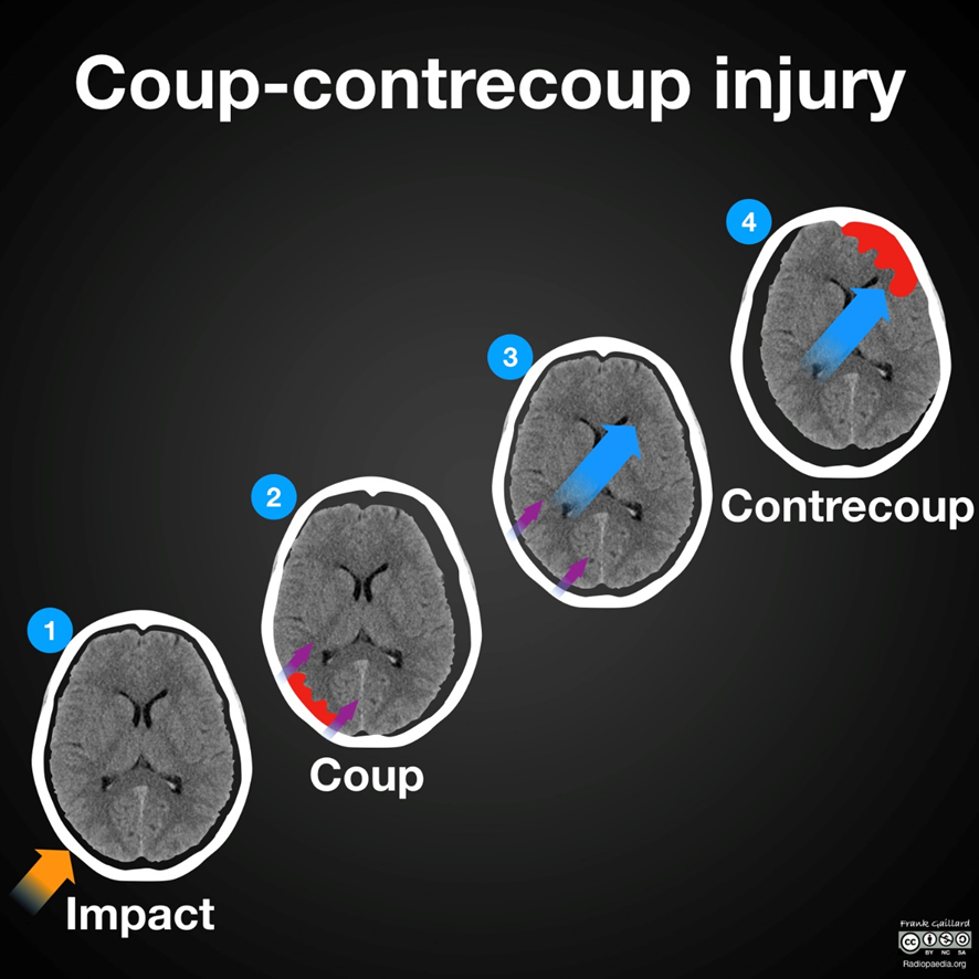 coup-contrecoup injury