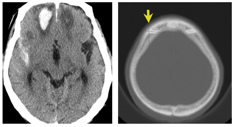 頭部CT画像　骨折と脳出血