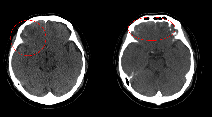 頭部CT画像　脳挫傷