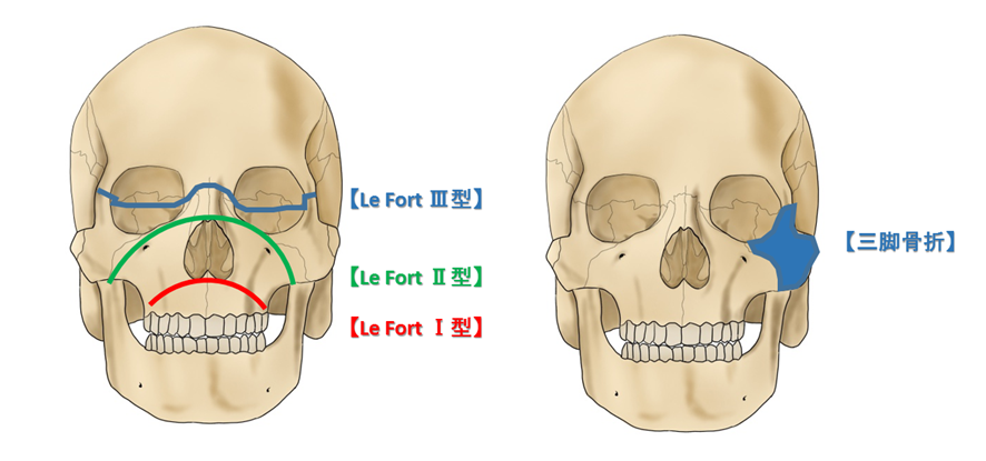 顔面骨折　分類