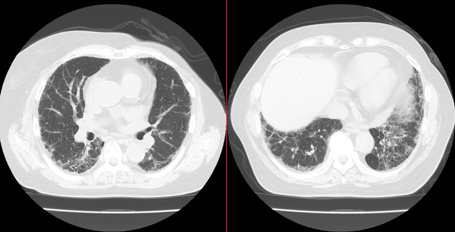 胸部CT-間質性肺炎